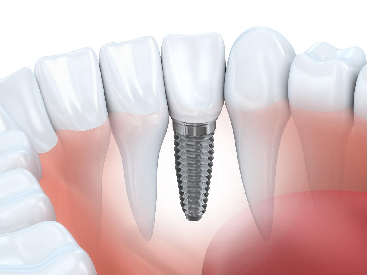 fogászati implantátum illusztráció